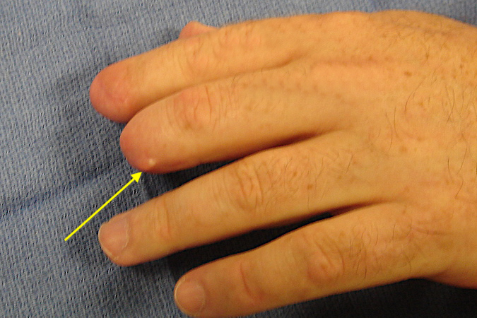 AMPUTATION, FINGER | Hand Surgery Resource